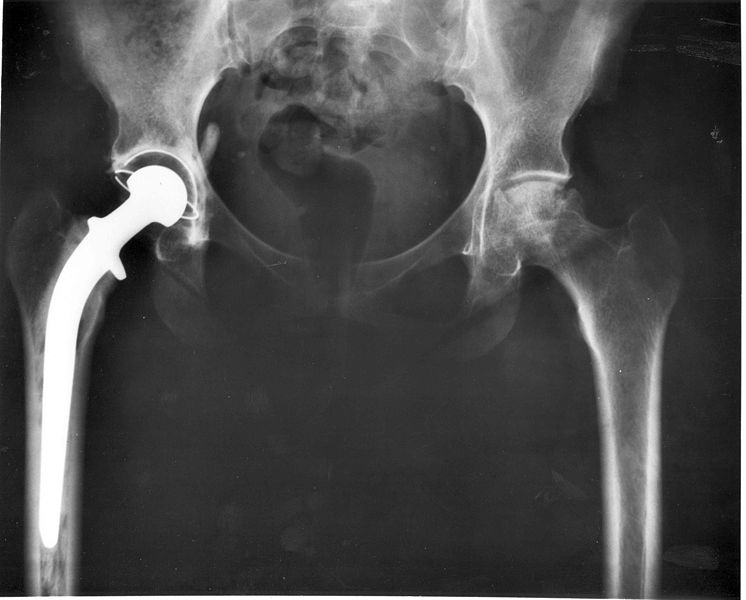 Bestand:746px-746px-Hip replacement Image 3684-PH.jpg