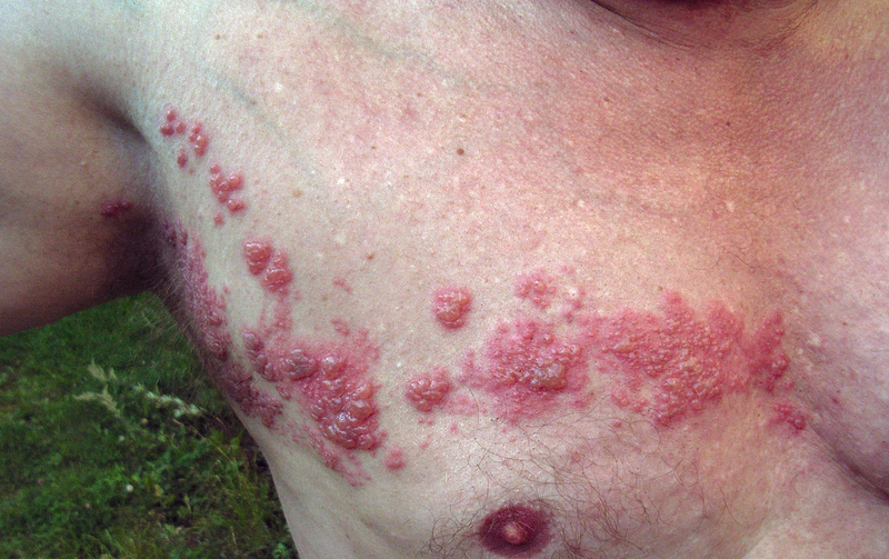 Bestand:800px-Herpes zoster chest.png
