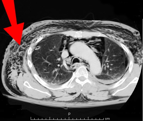 Bestand:Subcutaneous emphysema chest arrow.jpg