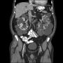 Miniatuur voor Bestand:600px-CT scan autosomal dominant polycystic kidney disease.jpg