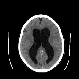 Een ct-scan van de hersenen met hydrocefalus (de donkere vlekken in het midden).