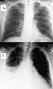 Miniatuur voor Bestand:358px-Pneumonia x-ray.jpg