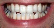 Miniatuur voor Bestand:800px-Teeth by David Shankbone.jpg