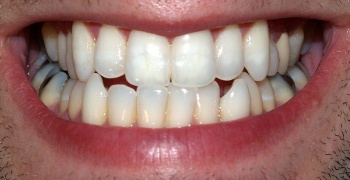 Martelaar Eentonig Transplanteren Tand (gebit) - Wikisage