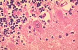 Aangetast weefsel uit de hersenen (Cerebellum), door het rabiësvirus welke hondsdolheid veroorzaakte.